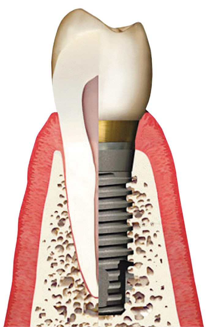 dental implant vs tooth