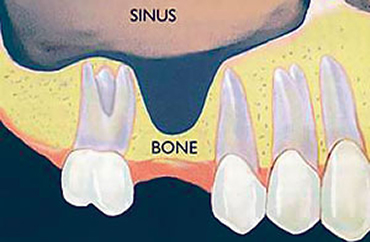 bone-graft and sinus-lift